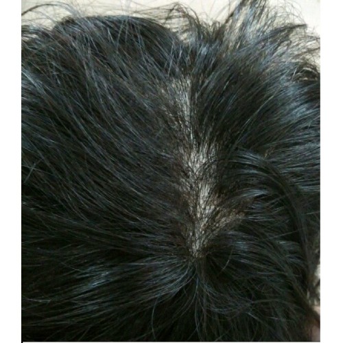 Hair Patch in Delhi