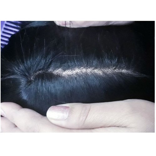 BMW men hair patch in Delhi supplier